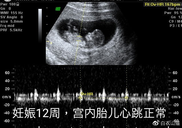 腹痛开始缓解,不过,医生还是给她做了检查,发现宫内胎儿心跳正常