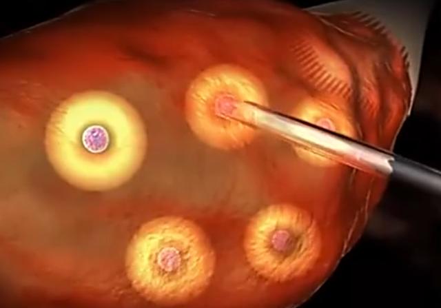 阿娇冷冻三颗卵子仍无孕组图揭秘冻卵过程心疼女人