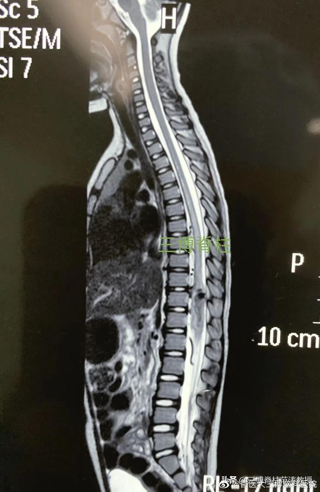 4岁的女孩,胸段脊髓内血管畸形突然出血截瘫