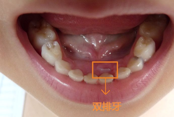6岁男娃长出"双排牙",无奈拔掉乳牙,医生表示和日常饮食有关