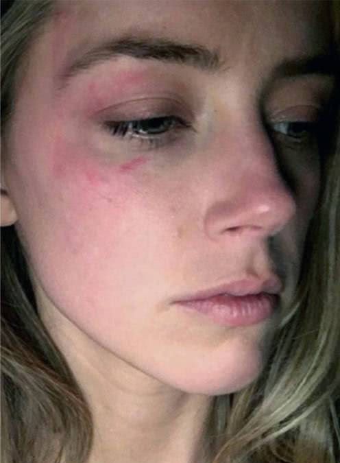 德普前妻家暴证据曝光?拿香烟烫脸用大酒瓶砸人