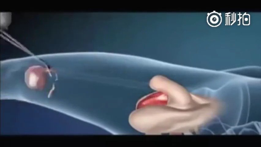 变性手术女变男的动画图片