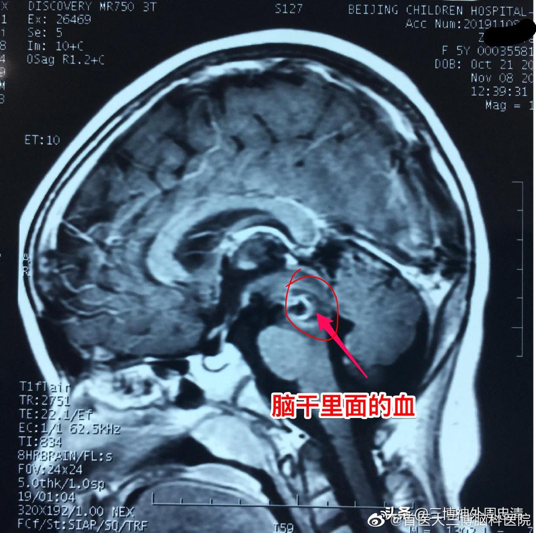 五岁女孩子突发脑干出血!危在旦夕