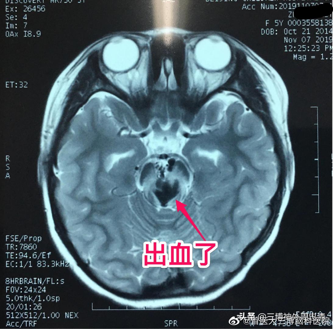 五岁女孩子突发脑干出血!危在旦夕