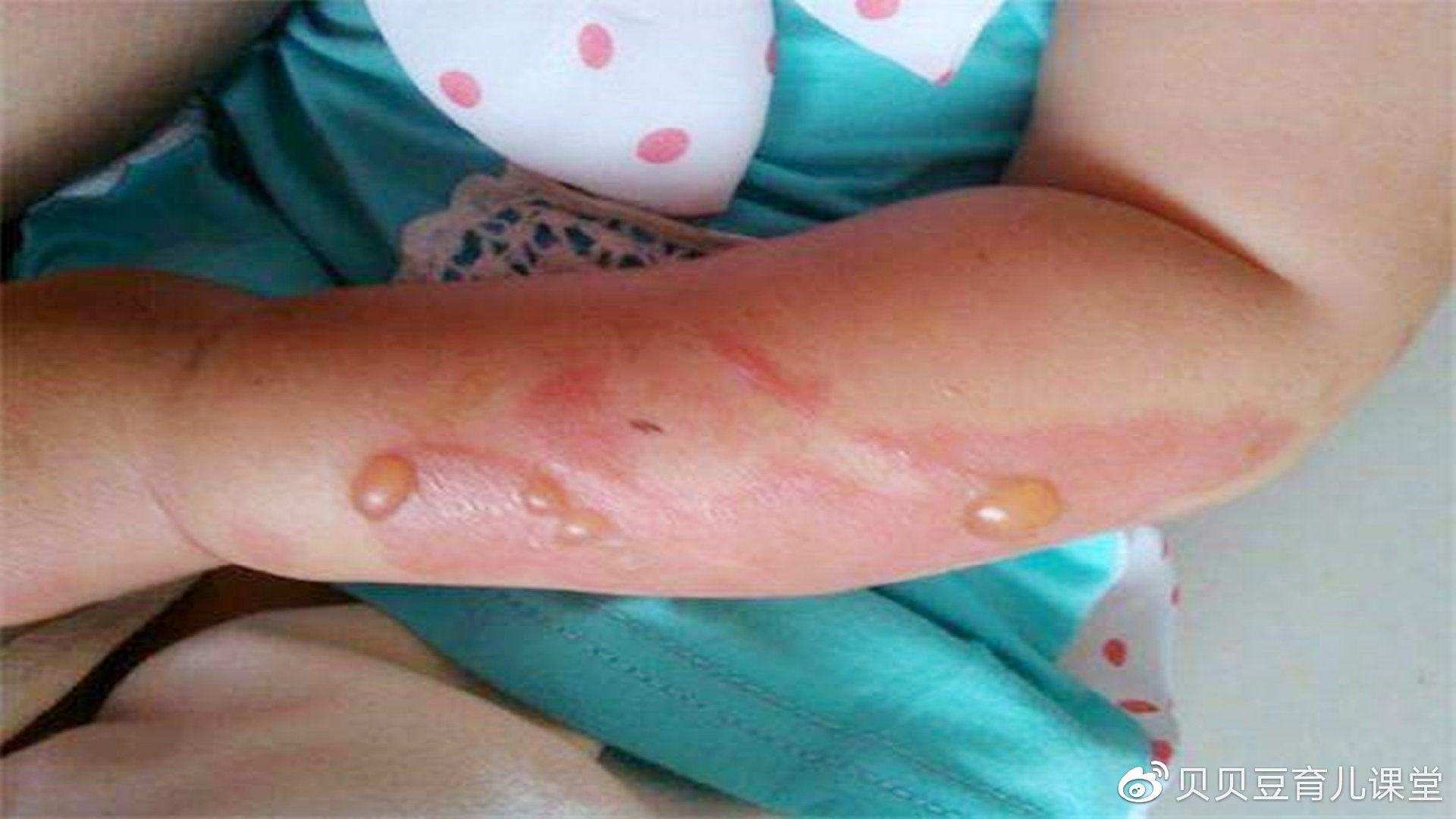 技术好!小孩烫伤怎么办"怀孕前期"-第2张图片-明城博客