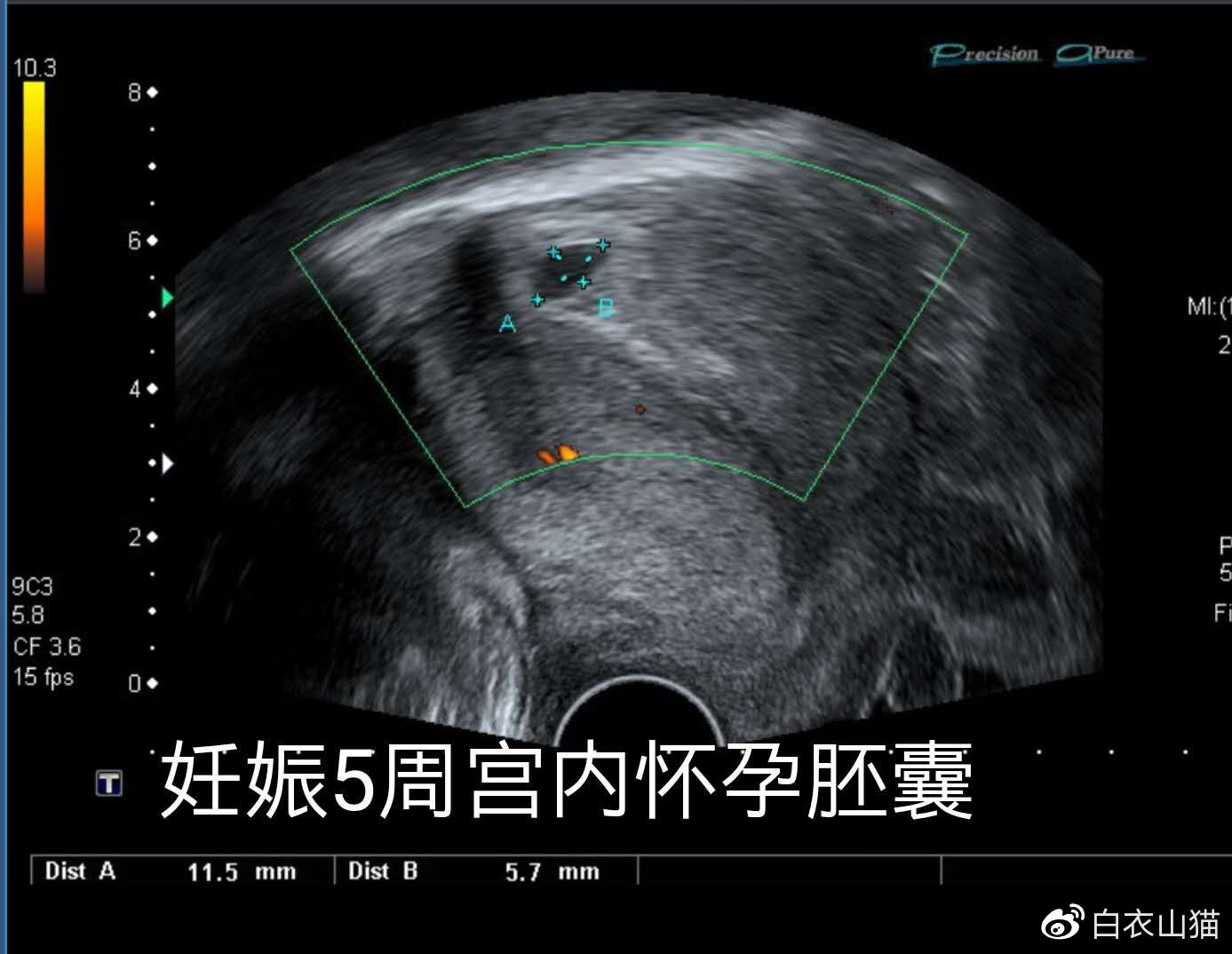 淘气双胞胎,一个在宫内,一个躲宫外.孕妈生命垂危,医生妙手回春!