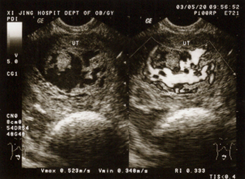 27岁女子产检怀了一串"葡萄"?葡萄胎是什么?这些原因要当心!