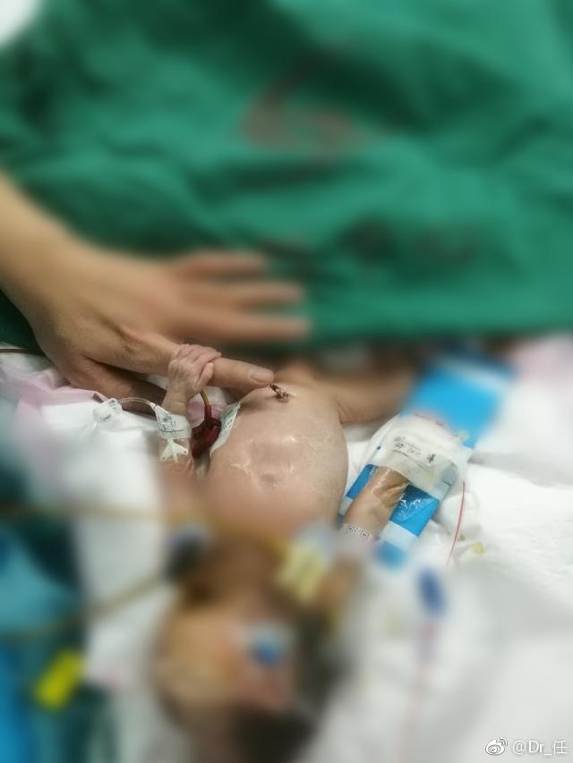 28周早产12公斤4毫米动脉导管未闭呼吸机支持下外院转入