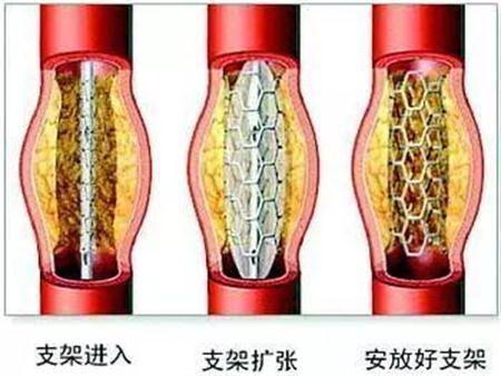 支架要定期换吗?冠心病支架手术8问8答