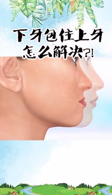 你有下牙包住上牙的情况吗?一副牙套轻松搞定