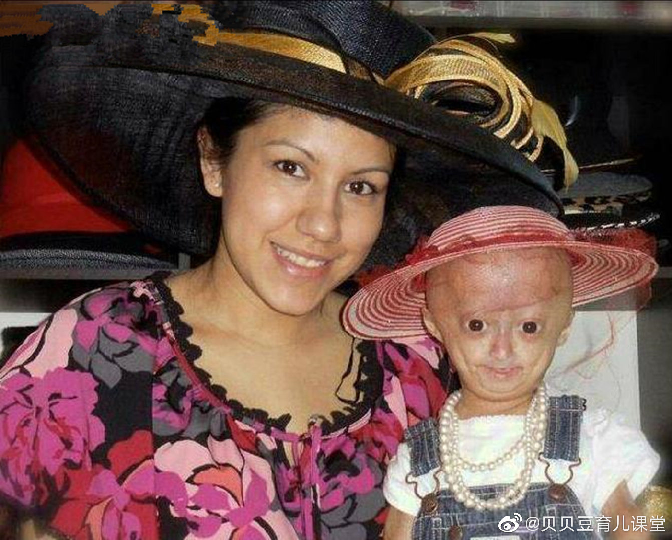 这个6岁的小女孩患有早衰症,刚出生时长的就像一个小老太婆