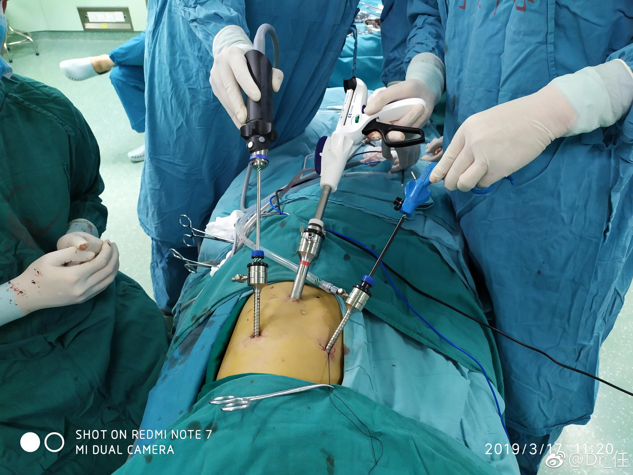 今天加班做 两台儿童胸腔镜肺囊腺瘤行肺叶切除