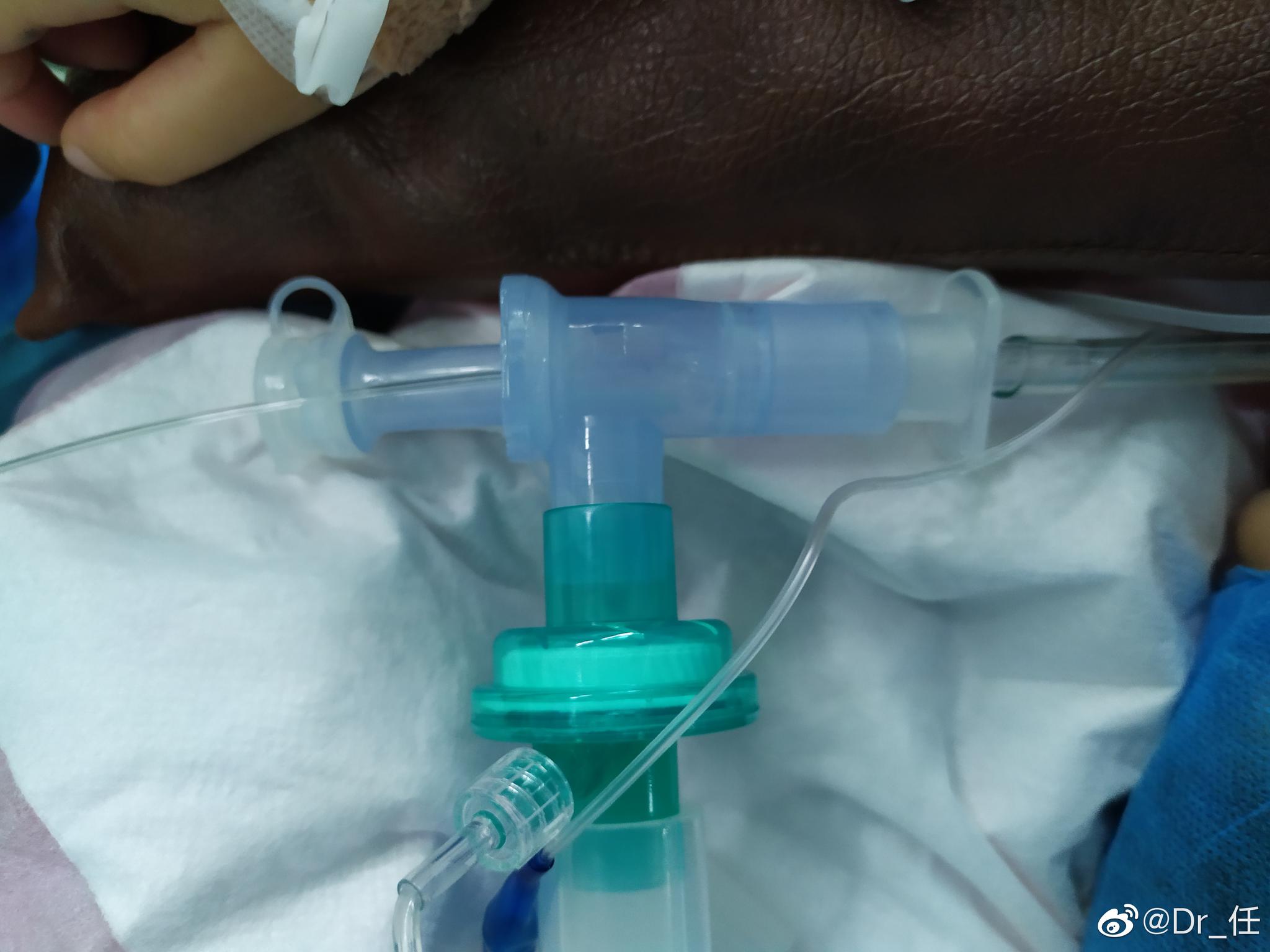 单肺通气可以为手术创造良好视野儿童无双腔管只能选择其他办法