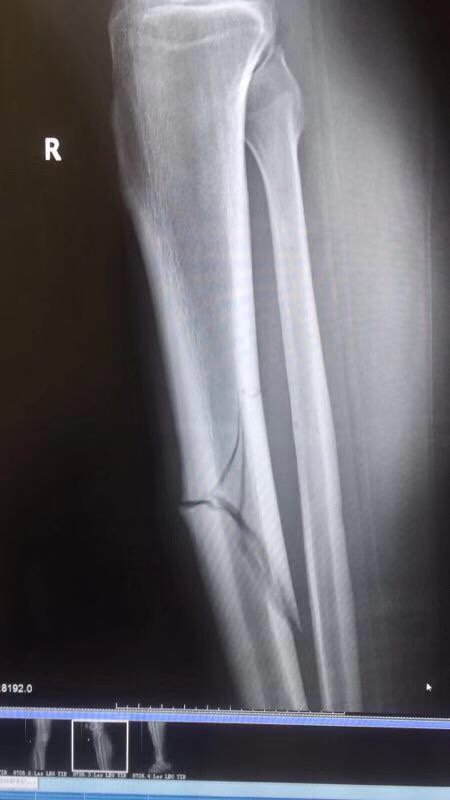 多拉多右腿胫骨骨折 首秀破门后遇重伤恐报销