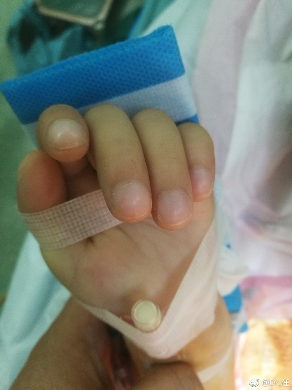 好久没见这么大孩子法四了,5岁,16公斤,血色素208g/l|血色素|杵状指