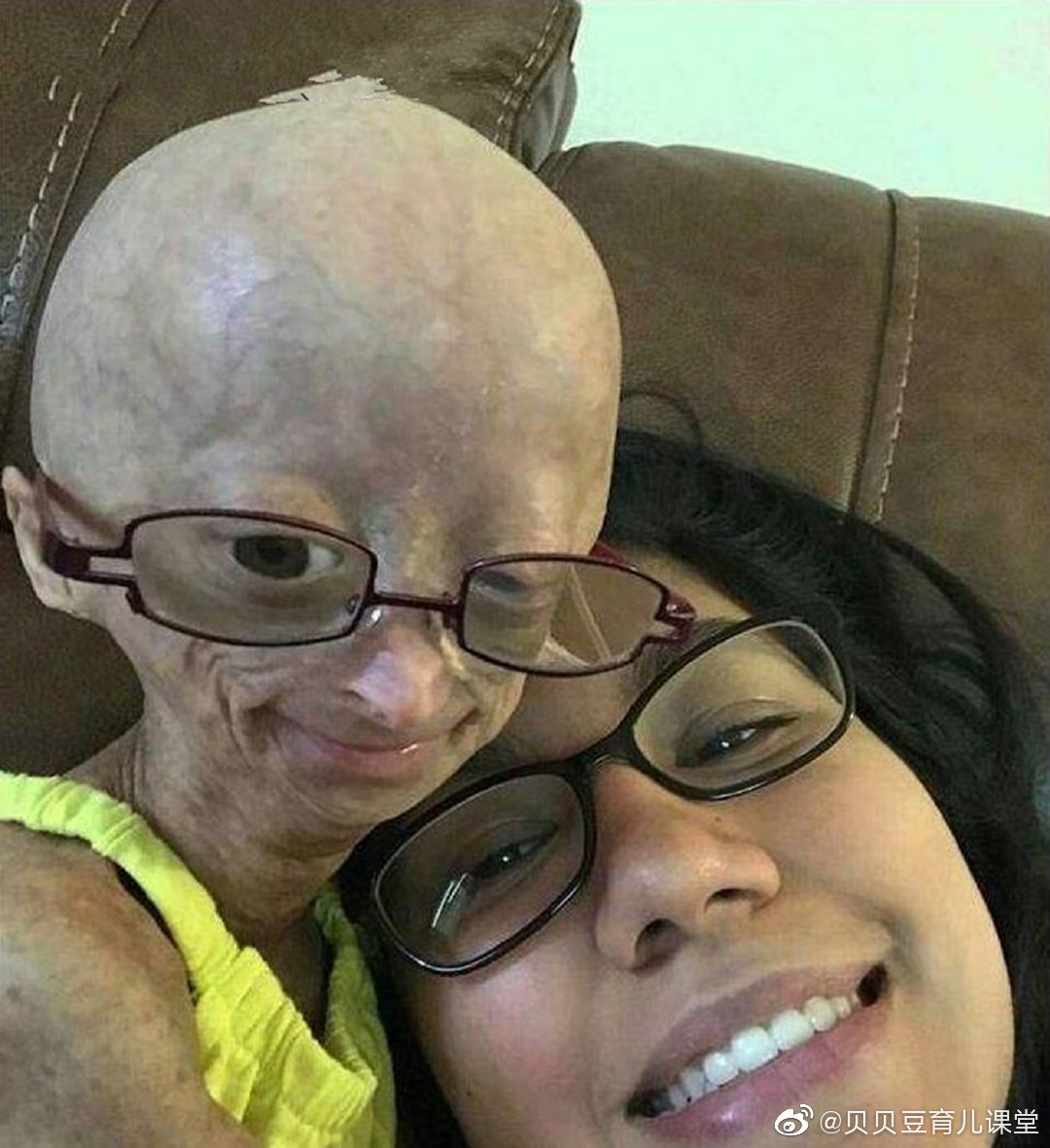 这个6岁的小女孩患有早衰症,刚出生时长的就像一个小老太婆