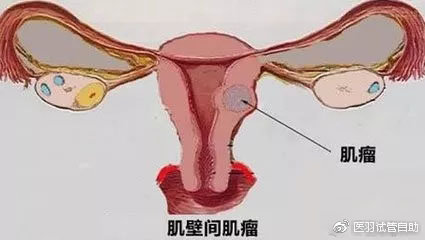 鞍形子宫可以做试管婴儿吗，有姐妹说是六种插图