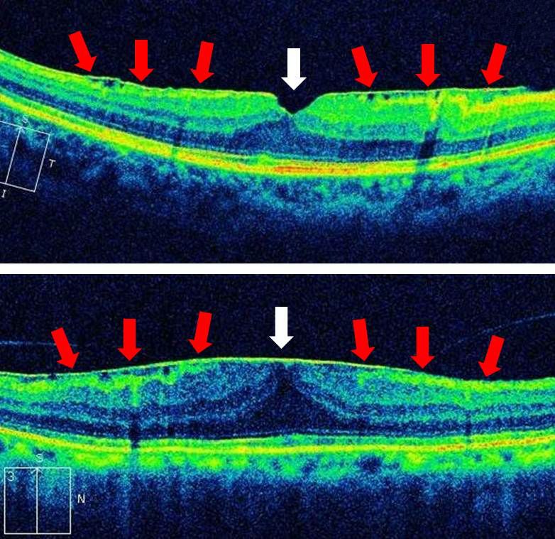 oct):上图为早期黄斑前膜患者(红色箭头),黄斑点正常凹位(白色箭头)