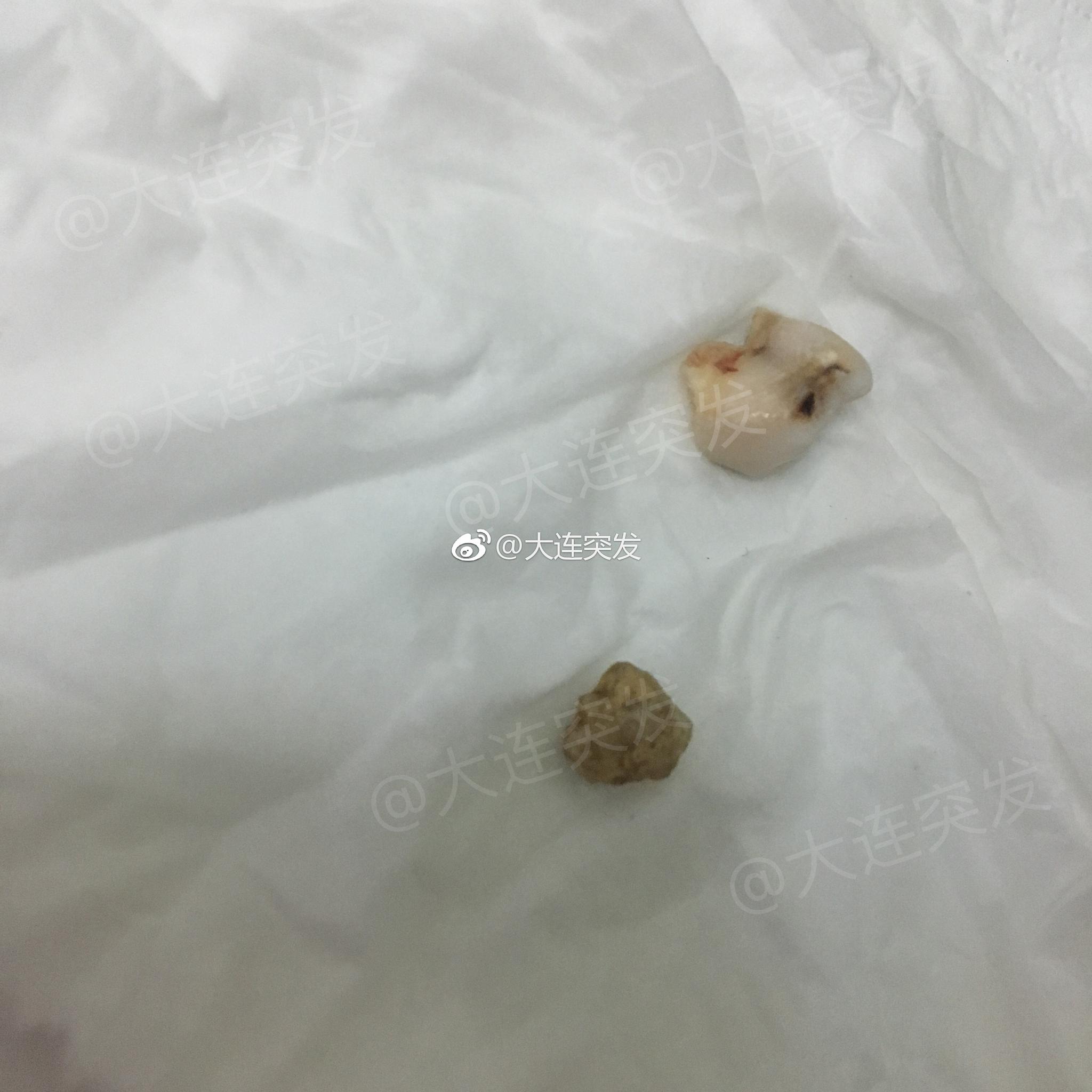 吃顿烧烤 硌碎一颗牙