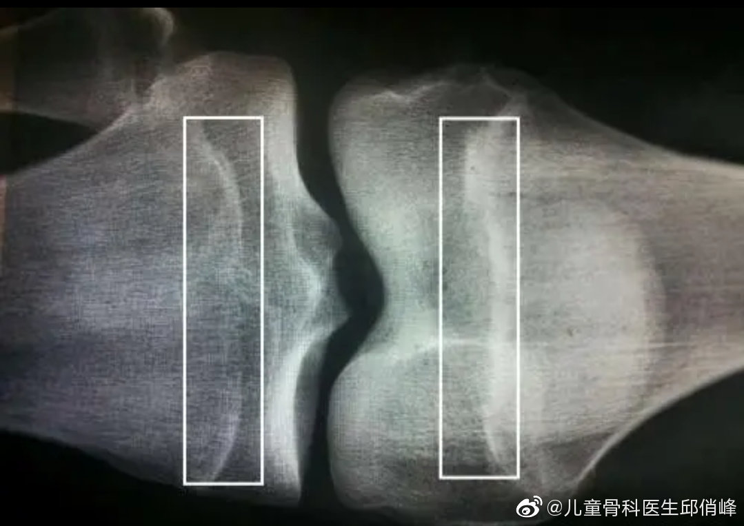 “医生，15岁女孩，身高只有1.50米，拍片骨骺已经闭合