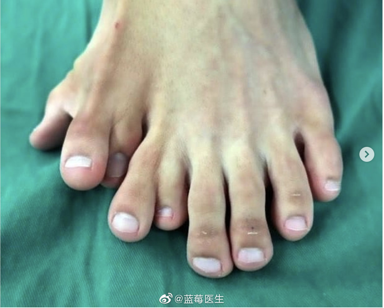 让你眼花缭乱的多指症,医生弄的效果怎么样?