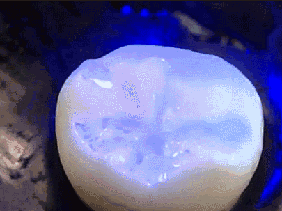 不吃糖和刷牙就不发生蛀牙吗?身为宝妈我竟然才知道窝沟封闭