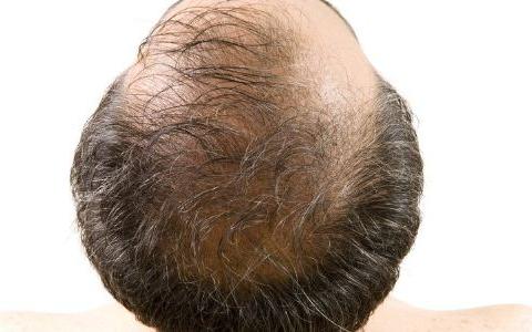 男人秃头很尴尬 怎样防止中年秃头|脱发|秃头|男性_新浪新闻