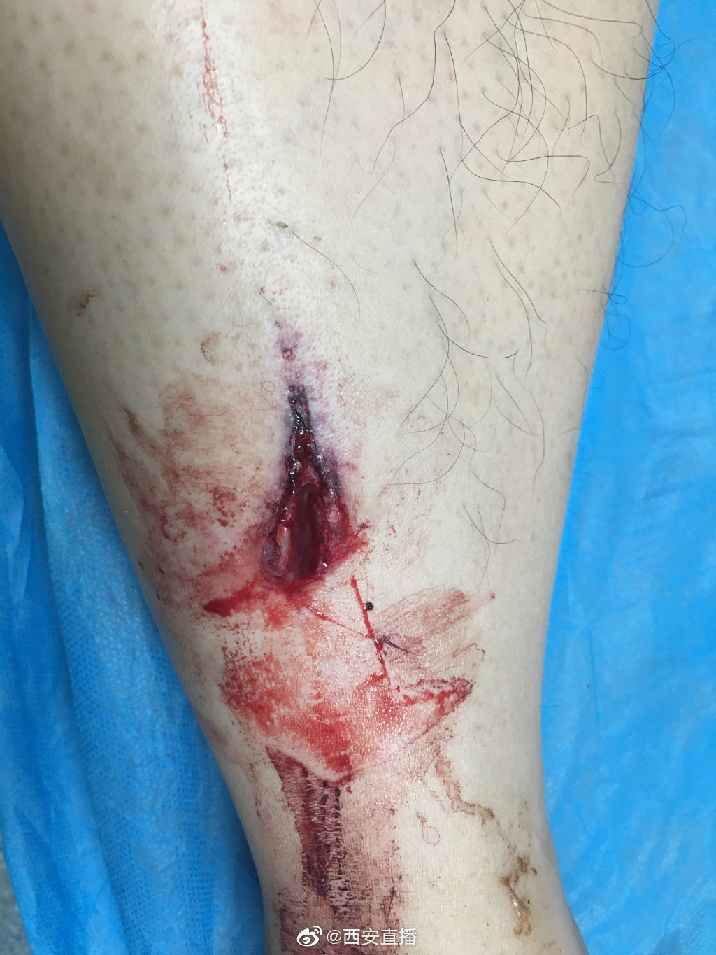 送到就近的五二一医院急诊室,护士进行了简单的处理就催促办卡缴费,我