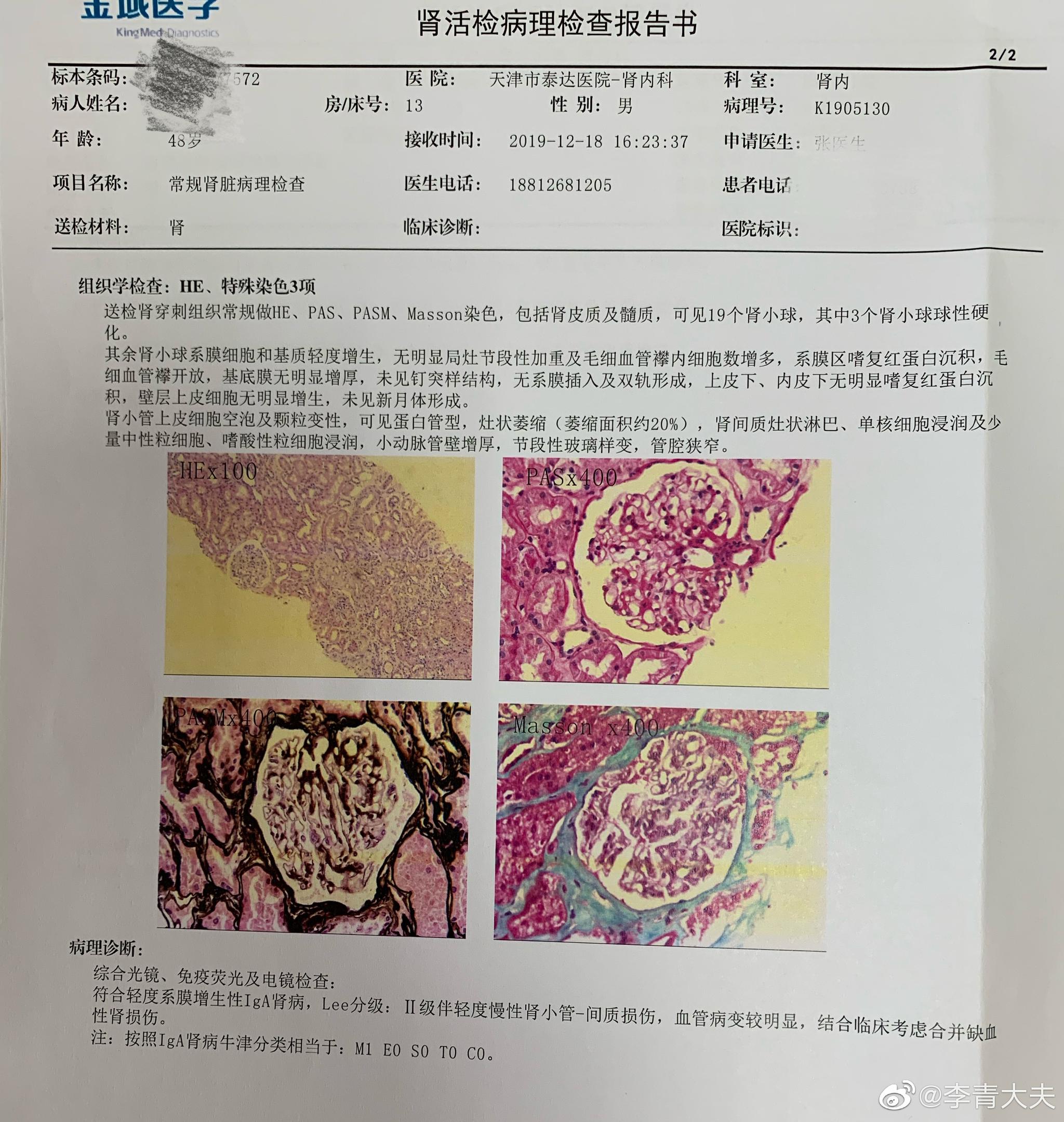 病理报告:缺血性肾损伤;慢性肾小管-间质损伤;轻度系膜增生性iga肾病