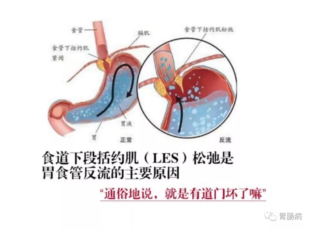 胃食管反流病患者饮食、生活的自我管理