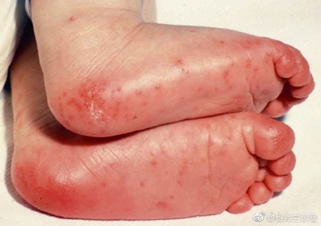 血管炎,主要累及冠状动脉,大约15%~25%未经治疗的儿童会发生冠状动脉