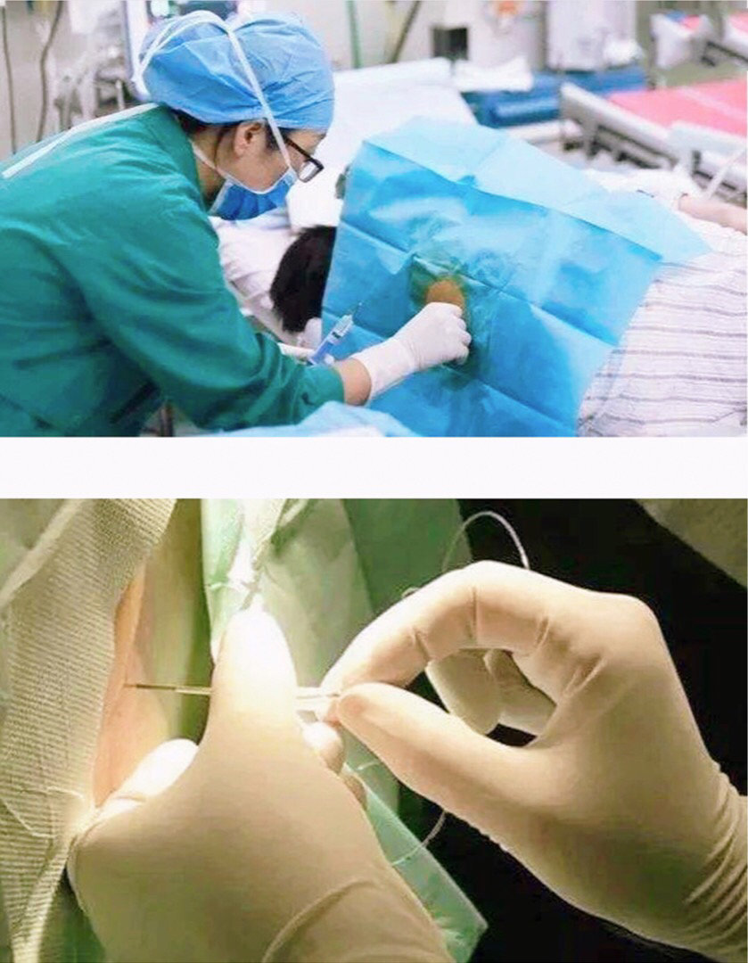 无痛分娩|镇痛泵|产妇|分娩_新浪新闻