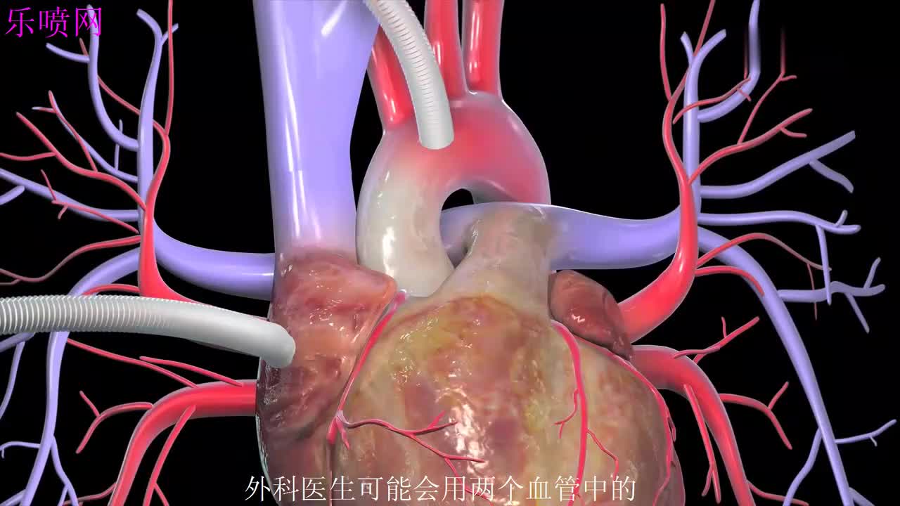 珠海首例 冠脉搭桥不用开胸 缝线比头发丝还细