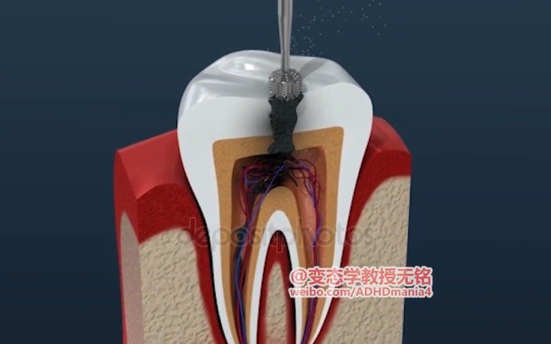 根管治疗牙根感染,牙髓坏死的治疗方法,把牙神经抽出来