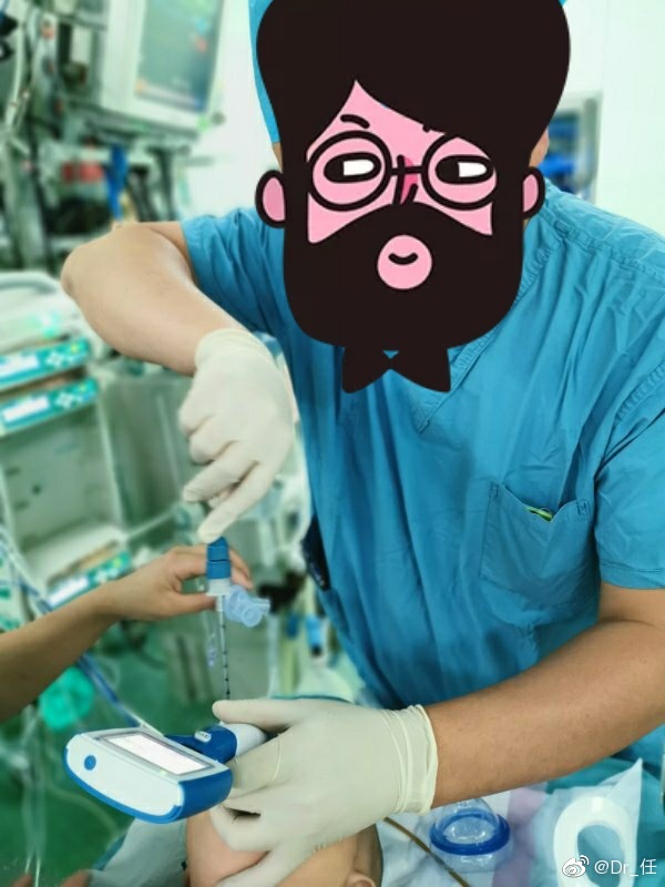 6月12公斤叶外型隔离肺气管导管外放置支气管封堵器