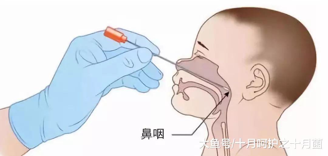 最简单,快速的就是鼻咽拭子检查.