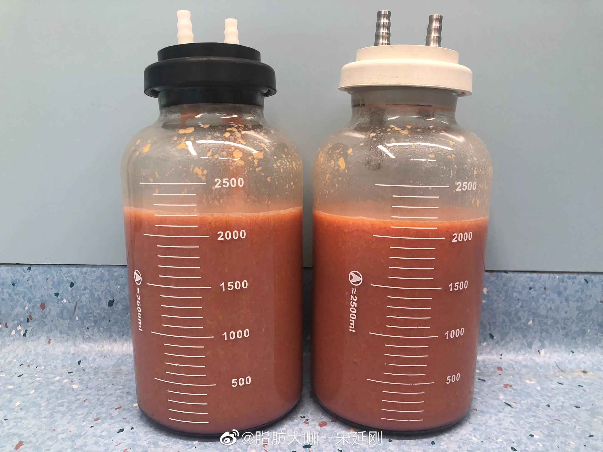 大腿吸脂|大腿吸脂|大腿|脂肪_新浪新闻