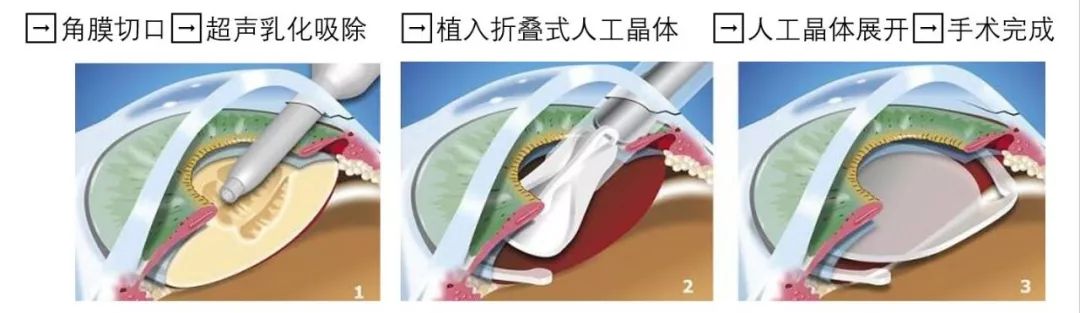 白内障手术步骤张大爷问题 8白内障摘除以后可不可以不放人工晶体?