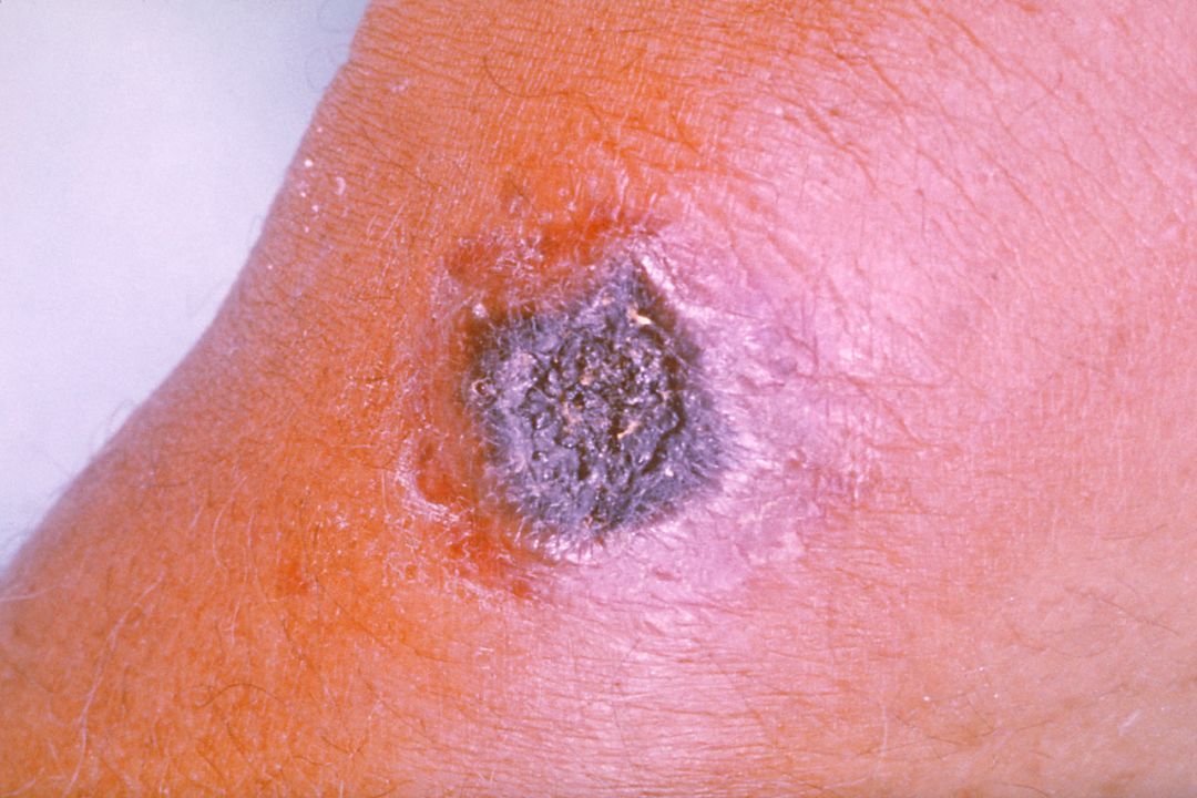 anthracis),人因接触病畜及其产品及食用病畜的肉类而感染炭疽杆菌后
