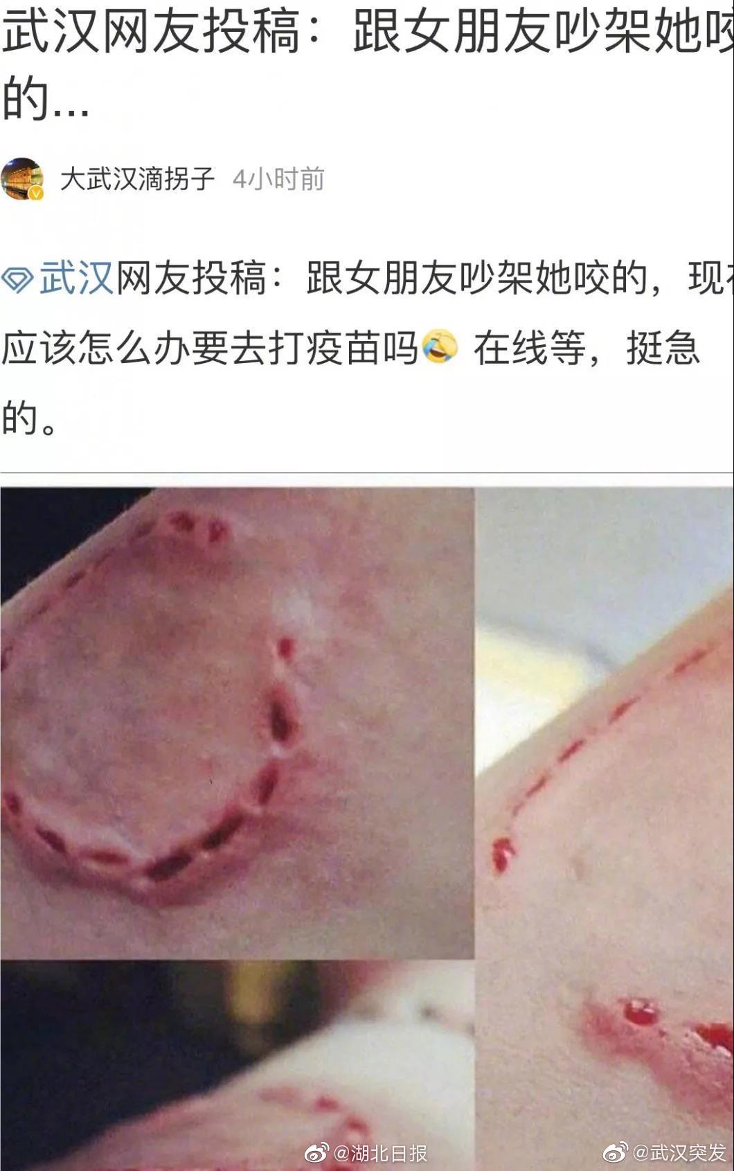 武汉一男子爆料被女友咬成这样,在线求助