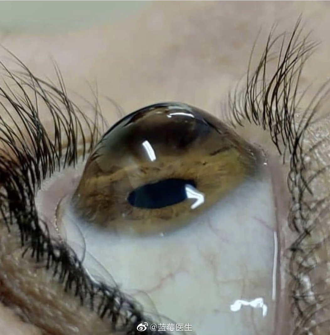 圆锥角膜,角膜扩张,中央变薄向前突出,呈圆锥形为特征的一种眼病