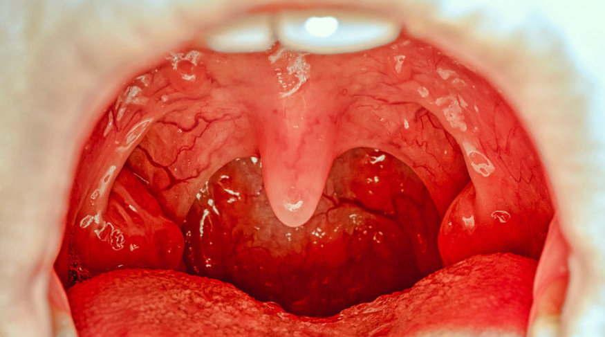咽喉癌图片 早期图片
