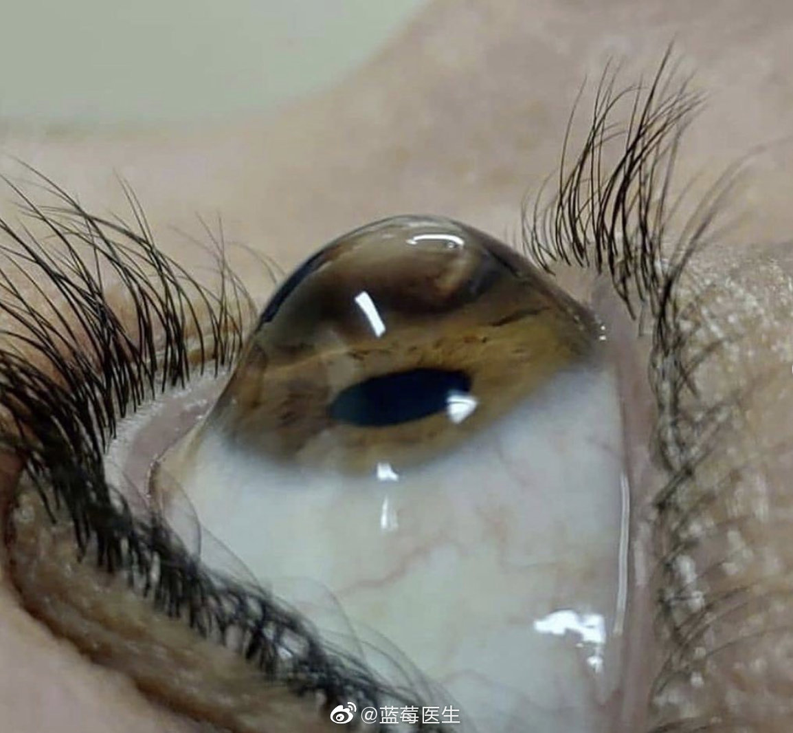 圆锥角膜,角膜扩张,中央变薄向前突出,呈圆锥形为特征的一种眼病