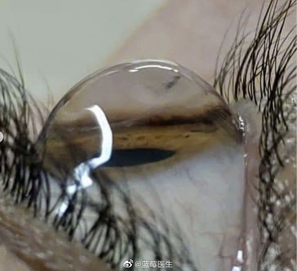 角膜接触镜在圆锥角膜治疗的临床应用 - 知乎