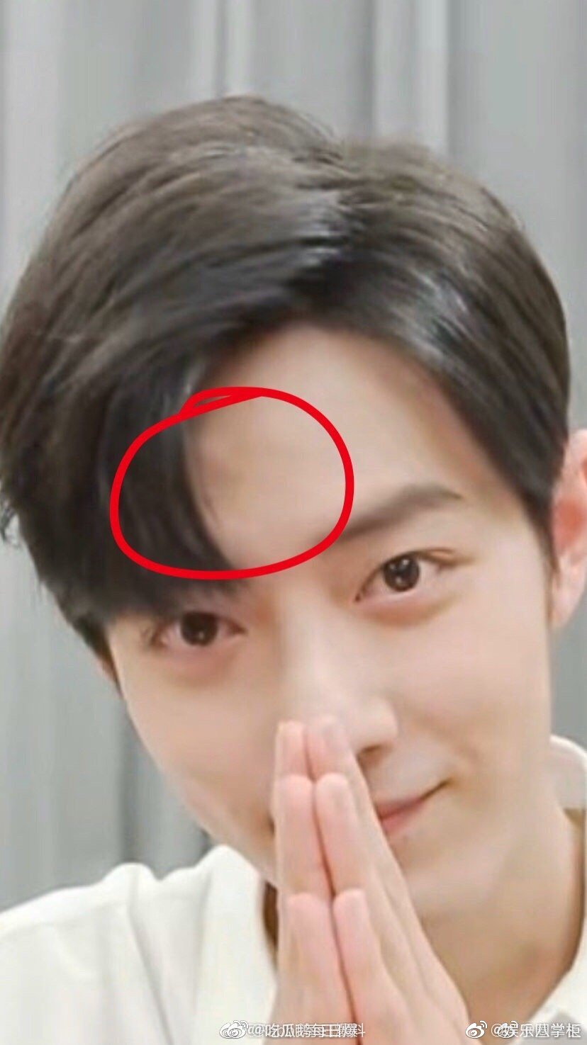 拜托各位理智追星吧!肖战被粉丝撞到头上起了大包