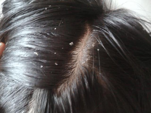 脱发真凶找到了!一旦查出长头螨,全家可能被传染,莫大意!