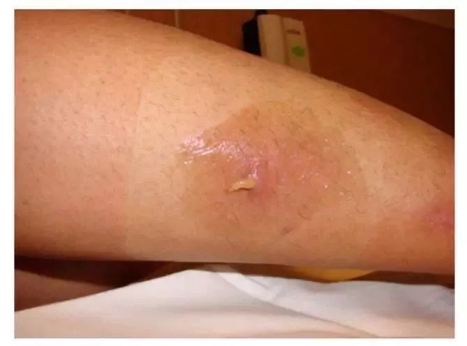 后,打开敷料时,她和医生不约而同地倒吸了一口冷气:一只肉色的虫子