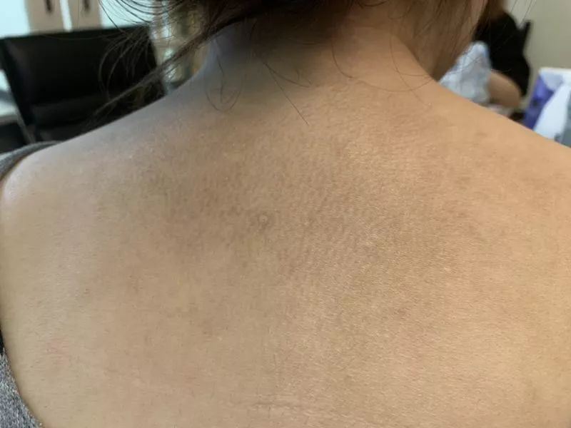 鸡皮肤黑色素沉淀变严重(如何改善鸡皮肤黑色素堆积) 鸡皮肤黑色素沉淀变严重(如何改善鸡皮肤黑色素堆积)