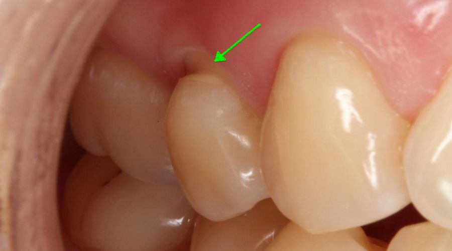 这个凹槽,可能会让你的牙齿被拦腰折断!