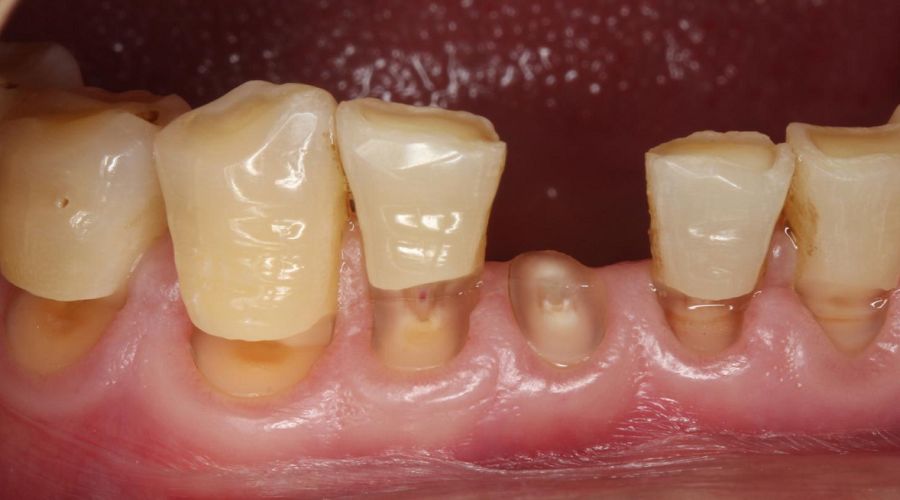 这个凹槽,可能会让你的牙齿被拦腰折断!